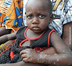 Ivorian child burnt by Trafigura toxic waste